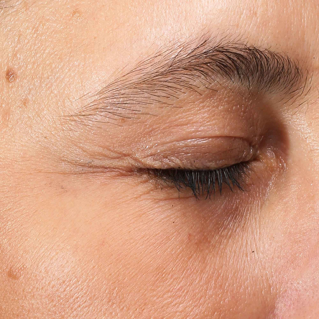 Crystal Retinal Ceramide Eye Before Asset
